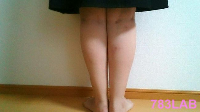 ビキャクイーンを履いて1ヶ月と1週間後の裸足の背面画像