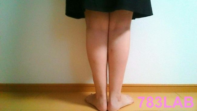 2か月間ビキャクイーンを履いた女性の背面の足の画像