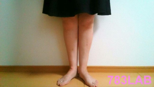 2か月間ビキャクイーンを履いた女性の足の画像